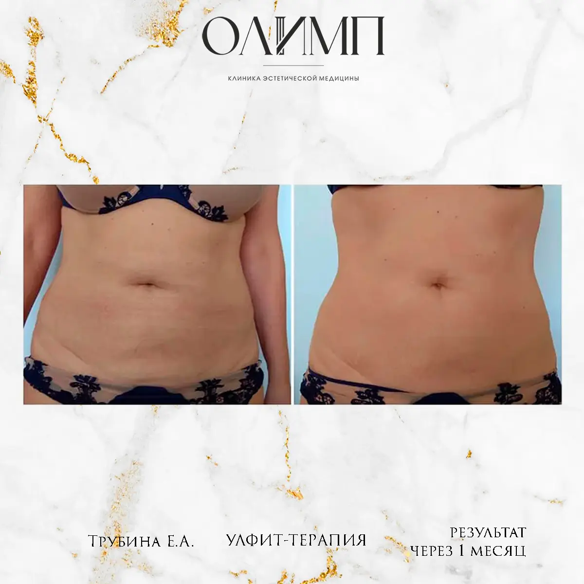 УЛФИТ терапия 6