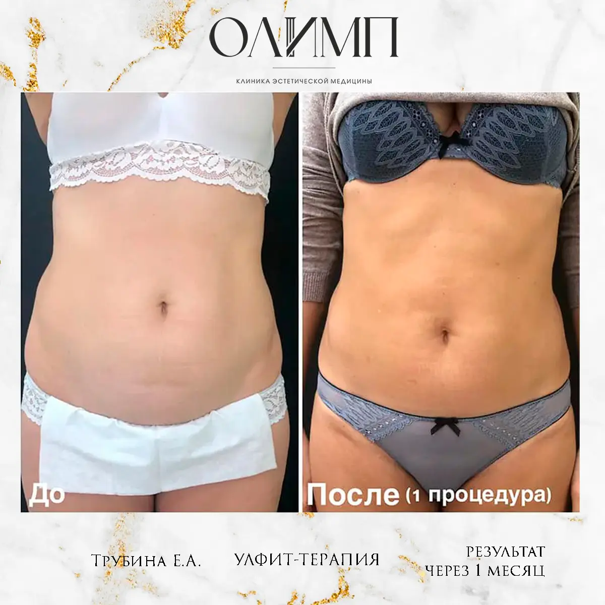 УЛФИТ терапия 9