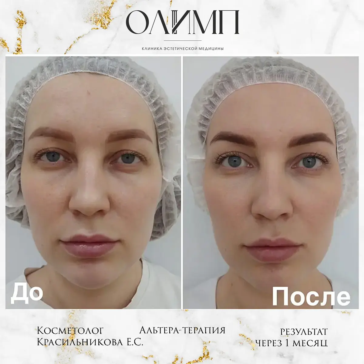 Альтера терпия 15