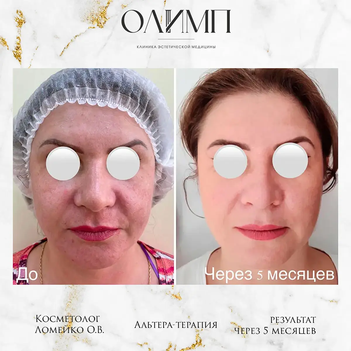 Альтера терпия 6