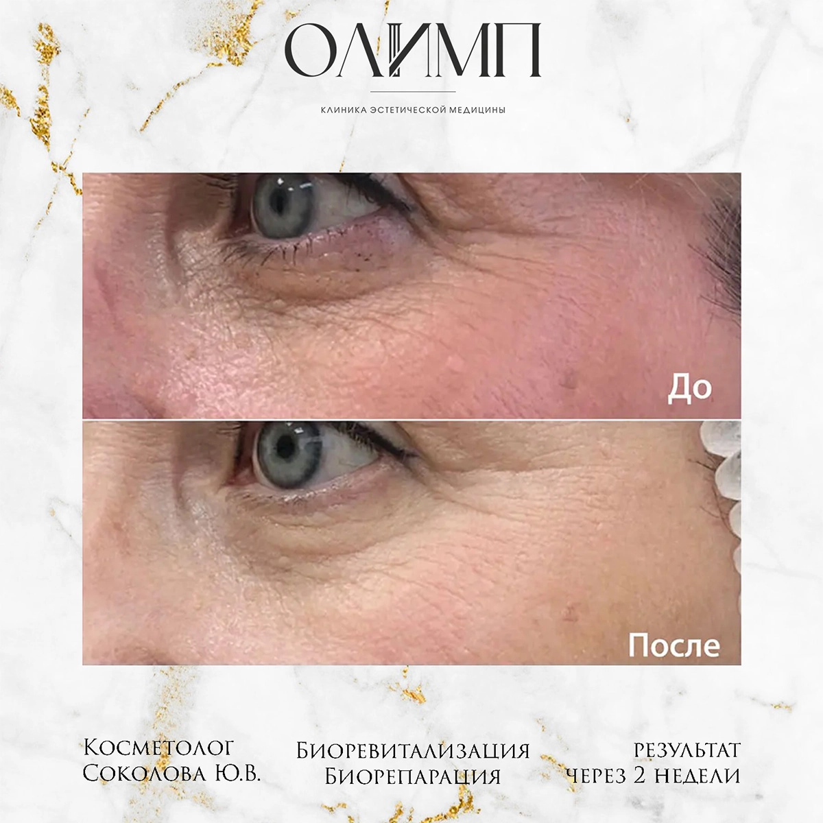 Биоревитализация 1