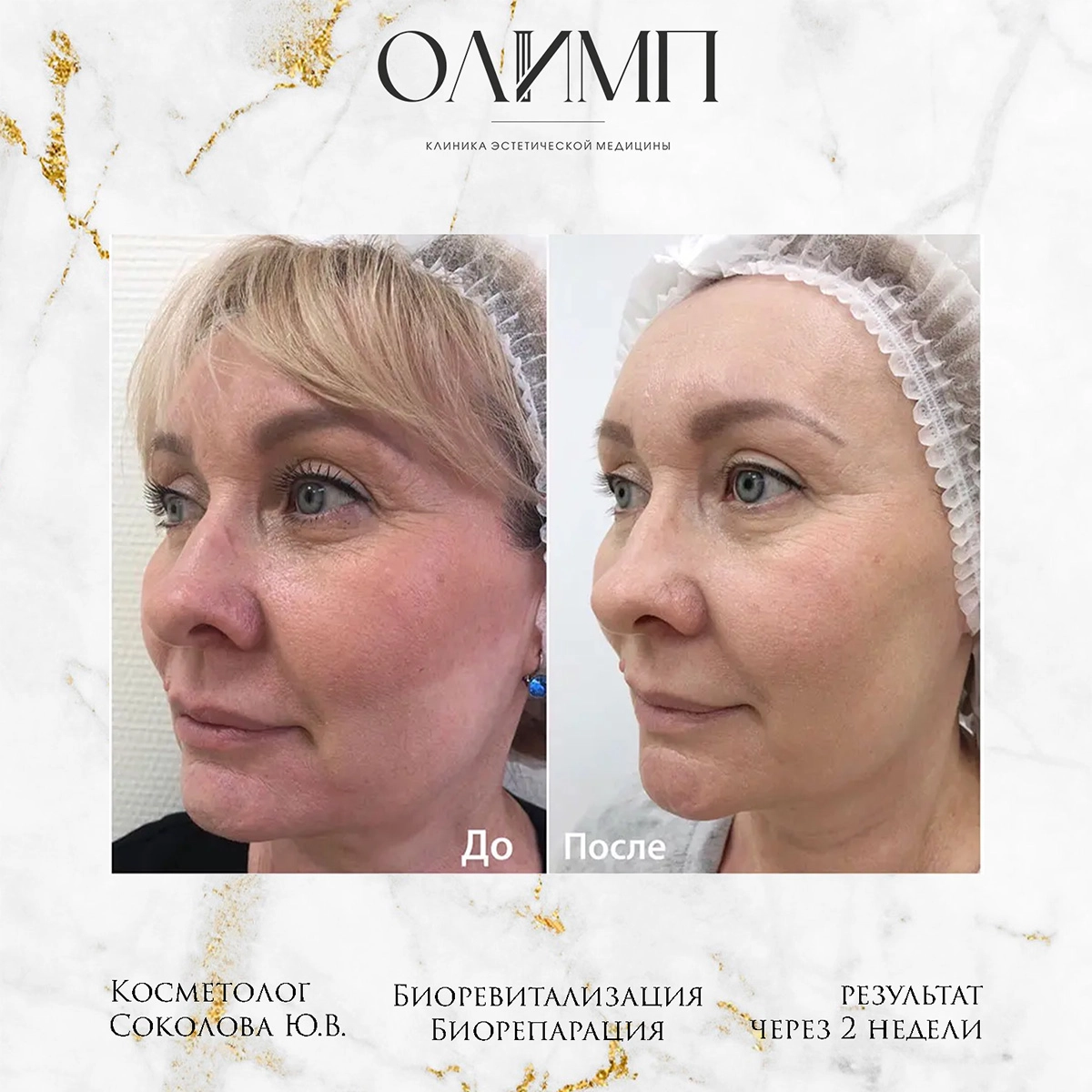 Биоревитализация 3