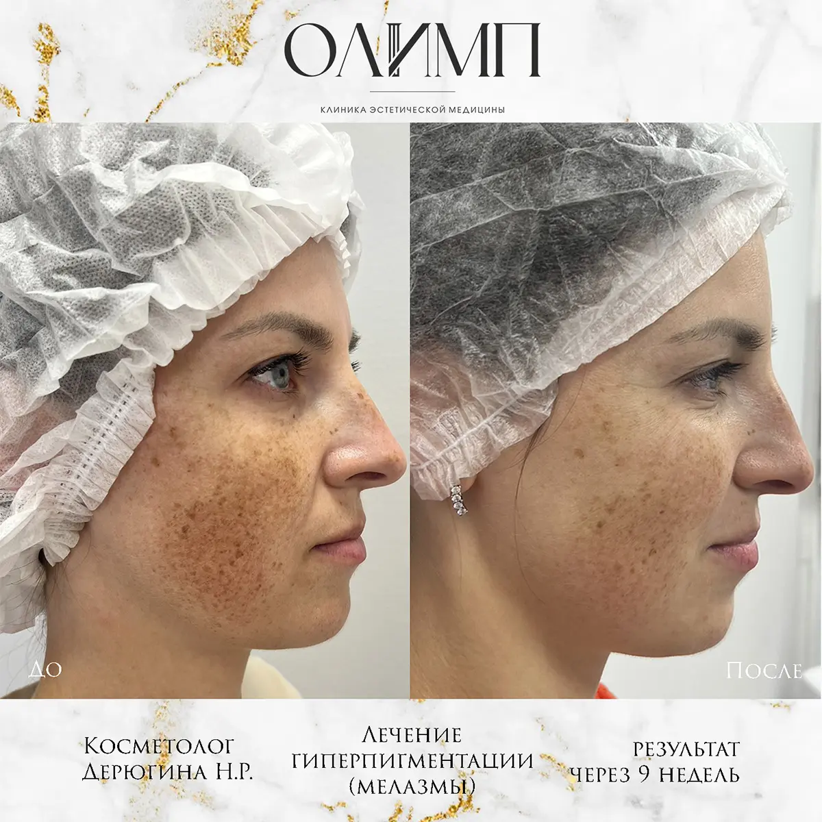 Биоревитализация 6