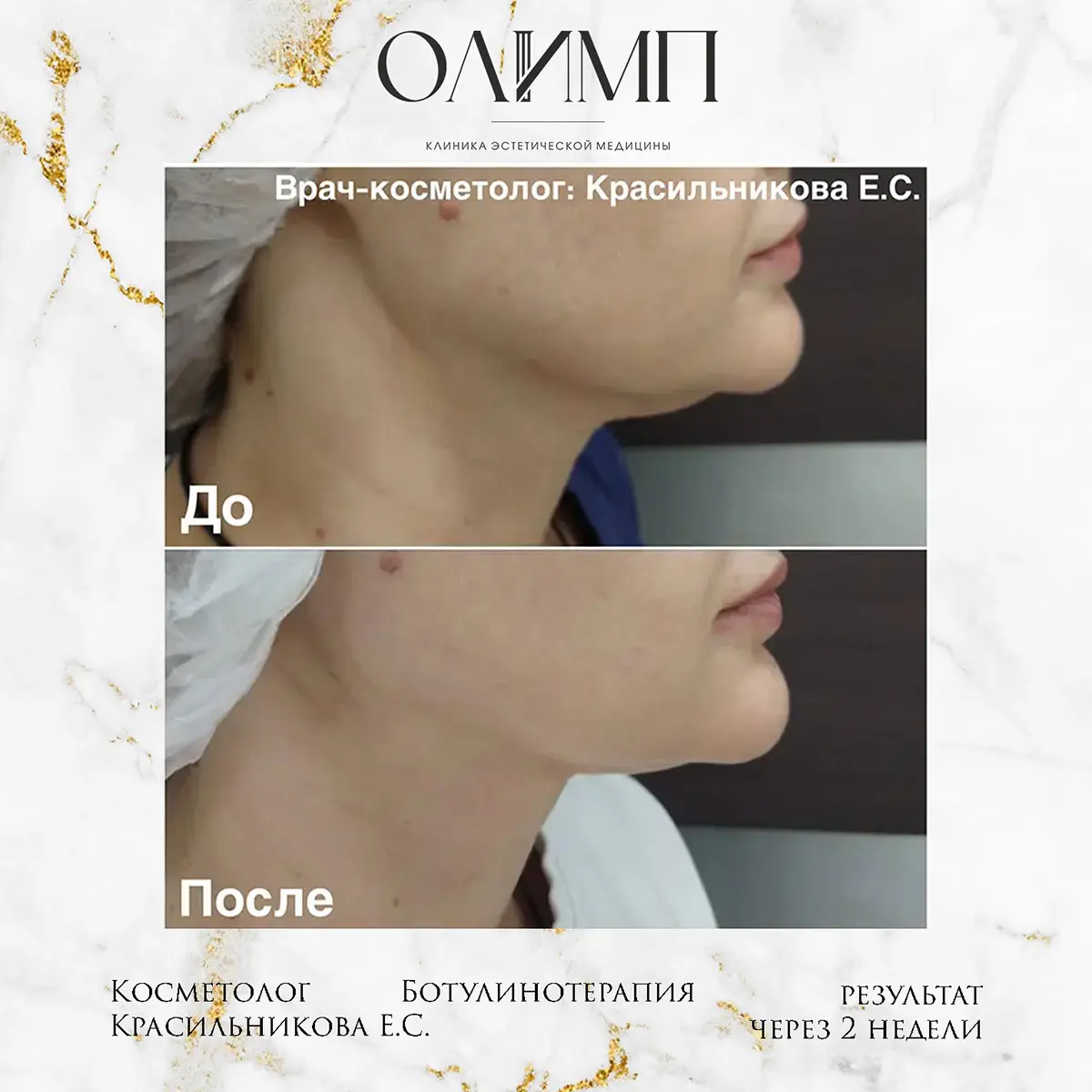 Ботулинотерапия 9
