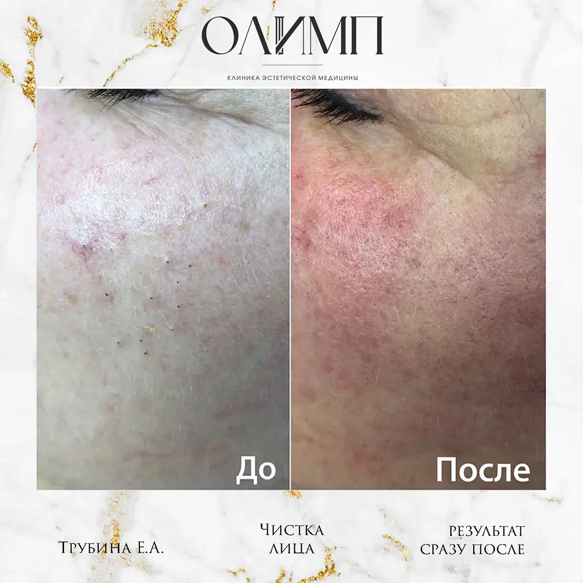 Чистка лица 1