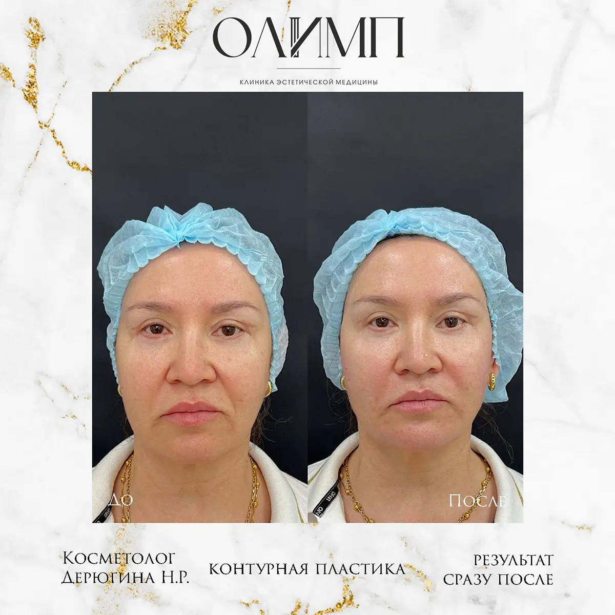 Контурная пластика 16
