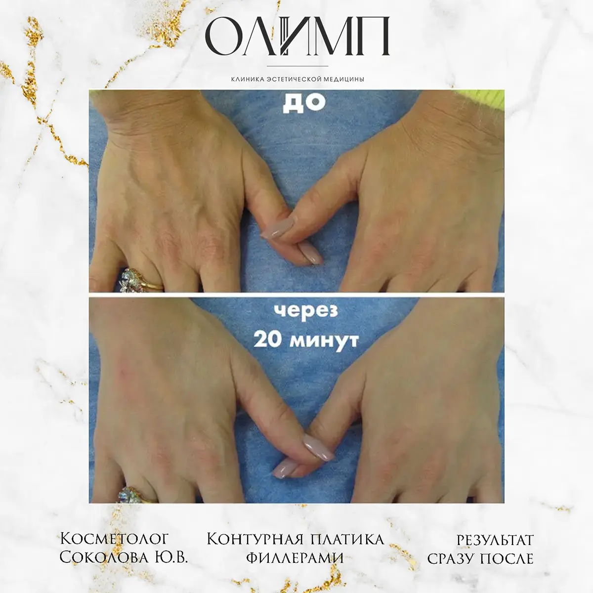 Контурная пластика 7