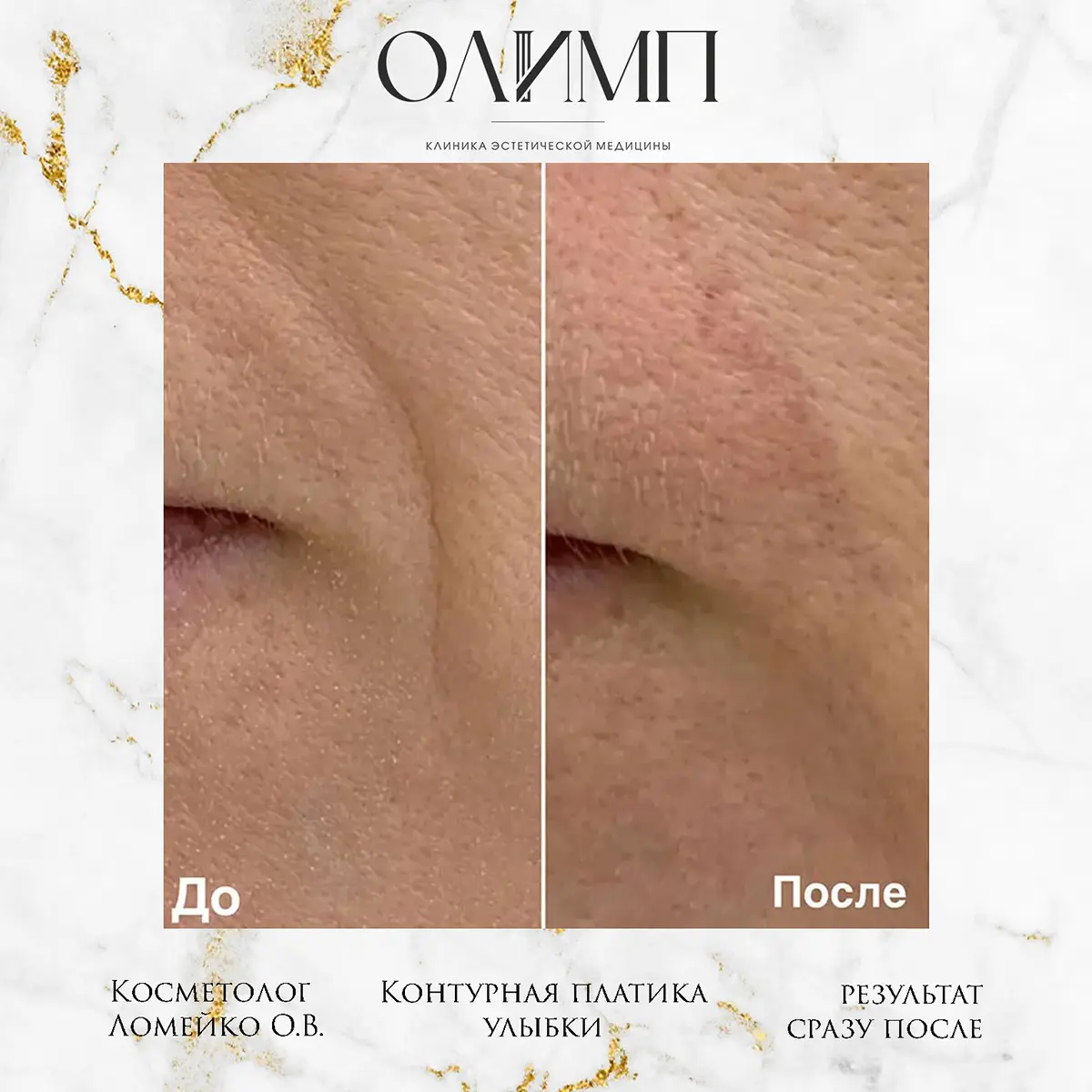 Контурная пластика 8