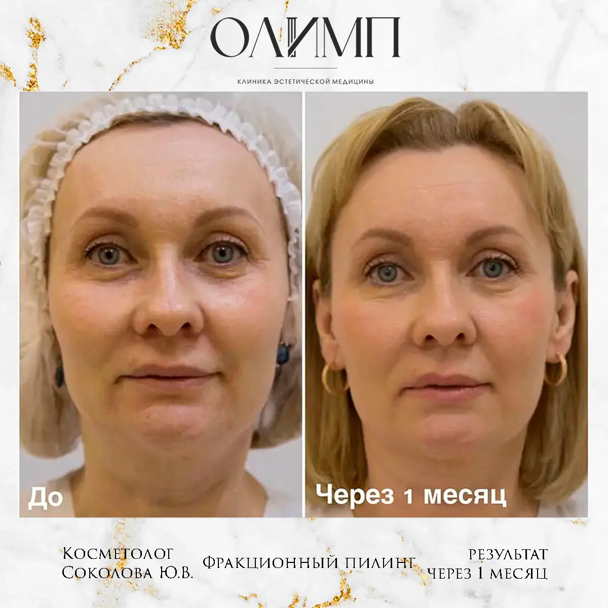 Пилинги 7